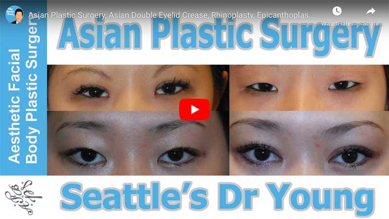 Eyelid Lift Bellevue WA - Blepharoplasty Seattle WA