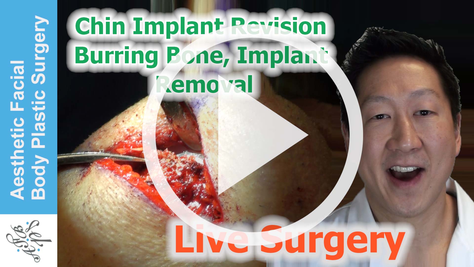 Chin Implant Revision Live Surgery, Bone Burring, Removal, & Replacement - Dr Young Bellevue Seattle