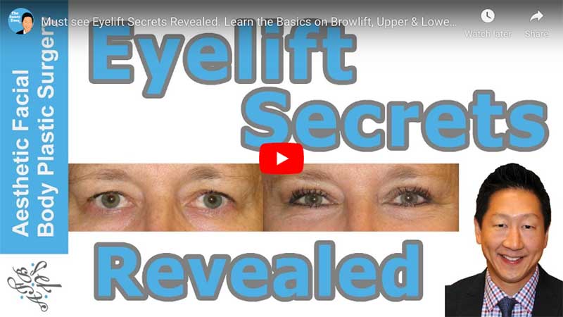 Must see Eyelift Secrets Revealed. Learn the Basics on Browlift, Upper & Lower Eye Lift, Seattle