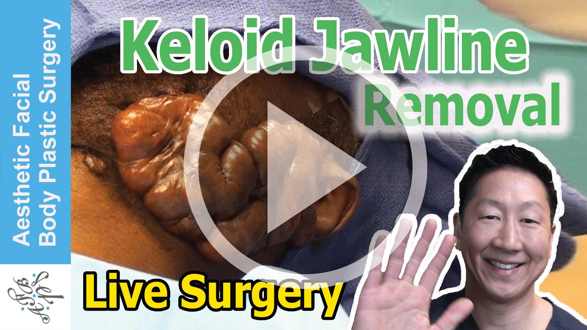Keloid Face, Beard, Jawline Scar Removal Treatment by Secondary Intention Healing