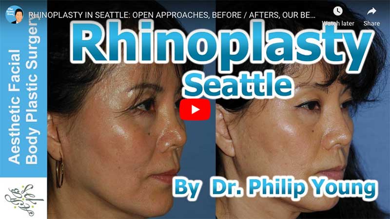 Rhinoplasty - Sattler Plastic Surgery, Seattle