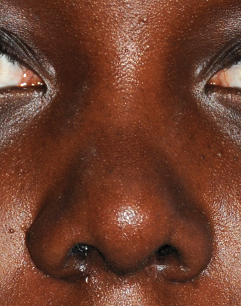 African American | Ethnic Rhinoplasty for Bulbous Tip, Tip Refinement and Projection African American | Ethnic Rhinoplasty for Bulbous Tip, Tip Refinement and Projection