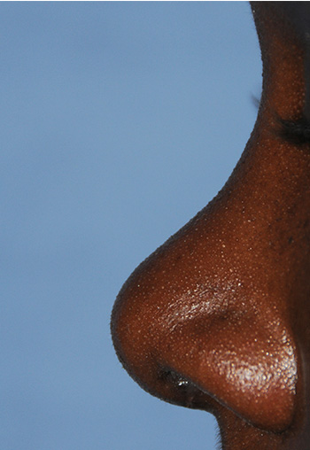 African American | Ethnic Rhinoplasty for Bulbous Tip, Tip Refinement and Projection African American | Ethnic Rhinoplasty for Bulbous Tip, Tip Refinement and Projection