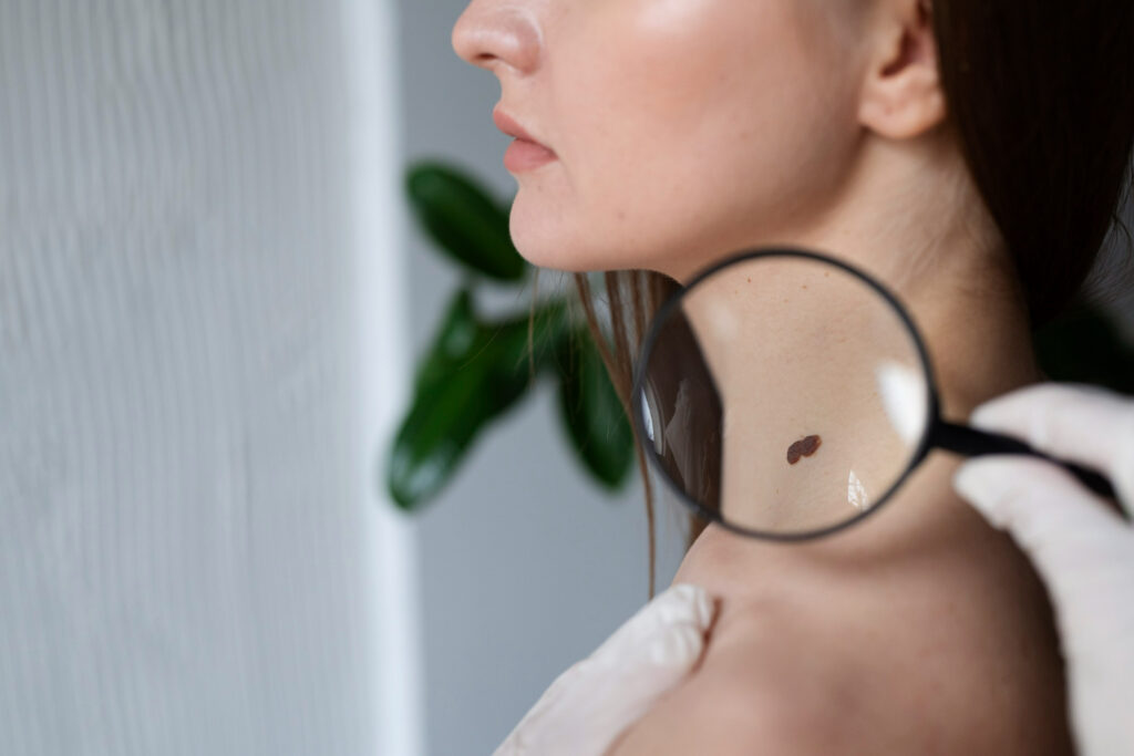 Why More Patients Are Choosing Cosmetic Mole Removal