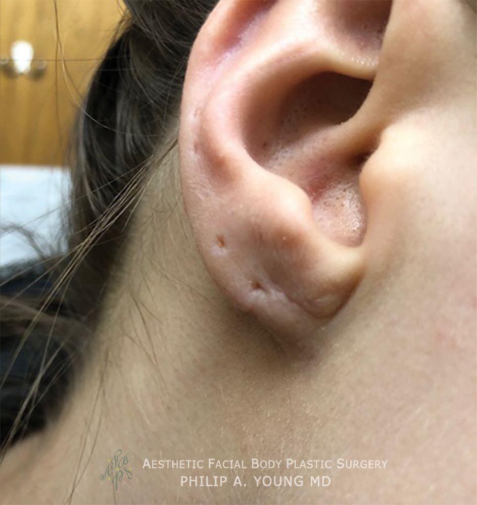 After Ear Reconstruction Repair for Gauged | Stretched | Torn Earlobes