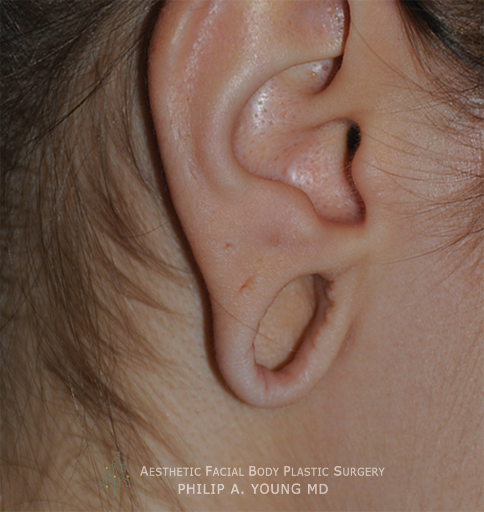 Before Ear Reconstruction Repair for Gauged | Stretched | Torn Earlobes