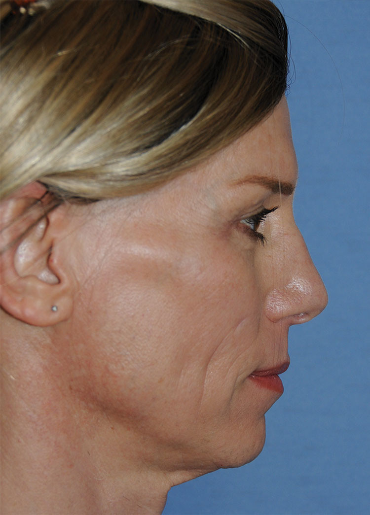 Before Transgender Feminization Rhinoplasty Procedure Side Profile