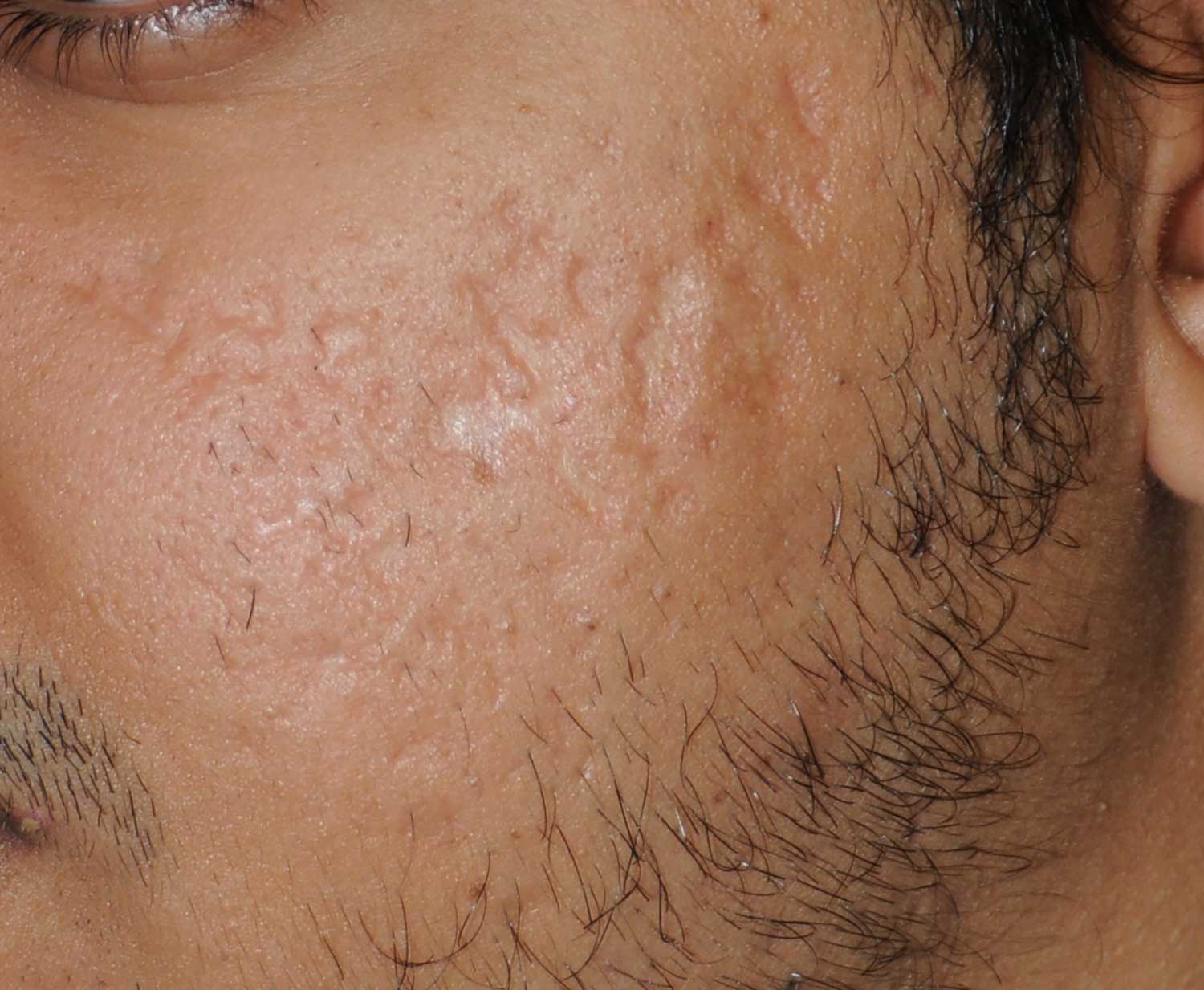 Acne Scar Treatment Before & After Photo