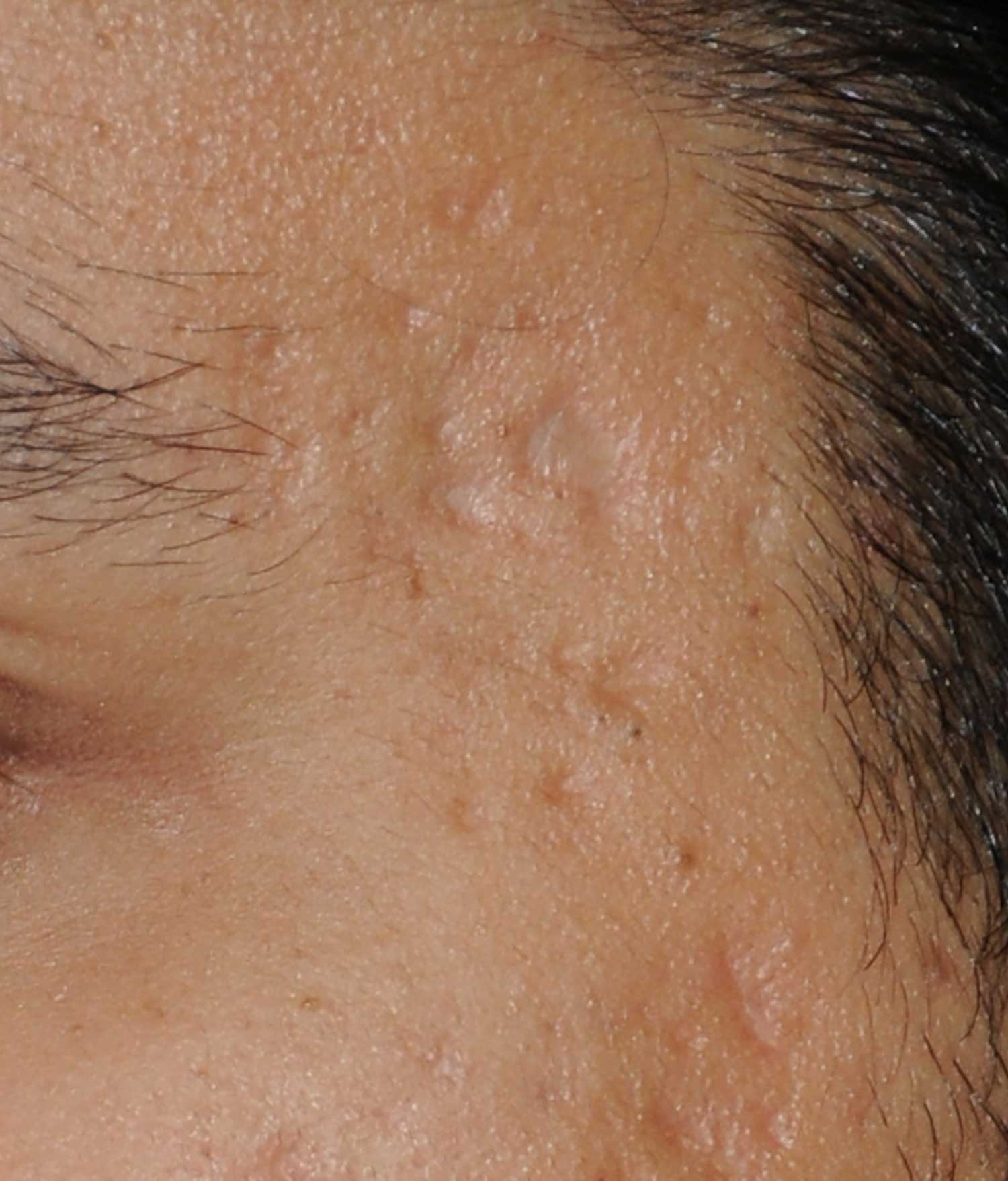 Acne Scar Treatment Before & After Photo