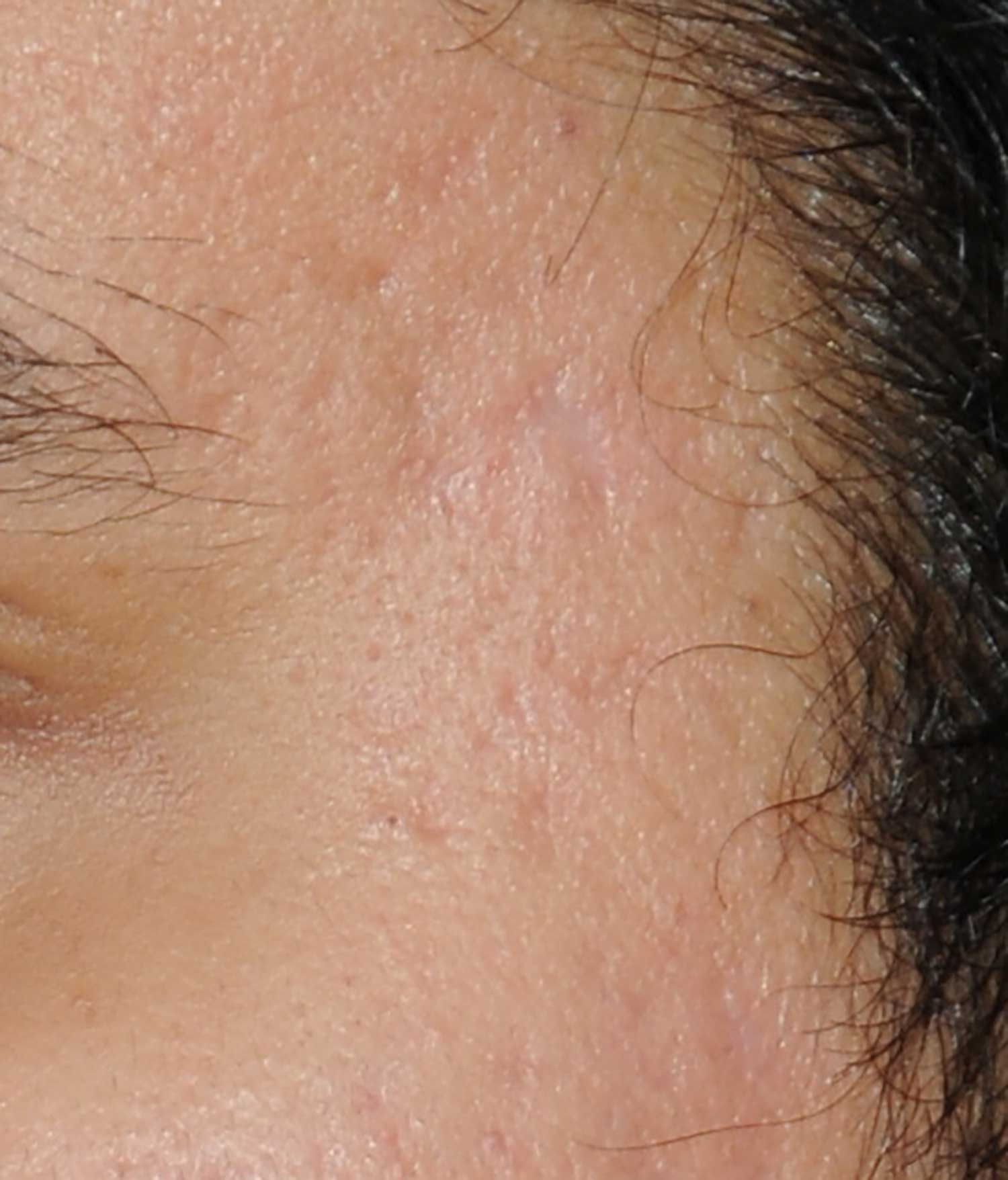 Acne Scar Treatment Before & After Photo