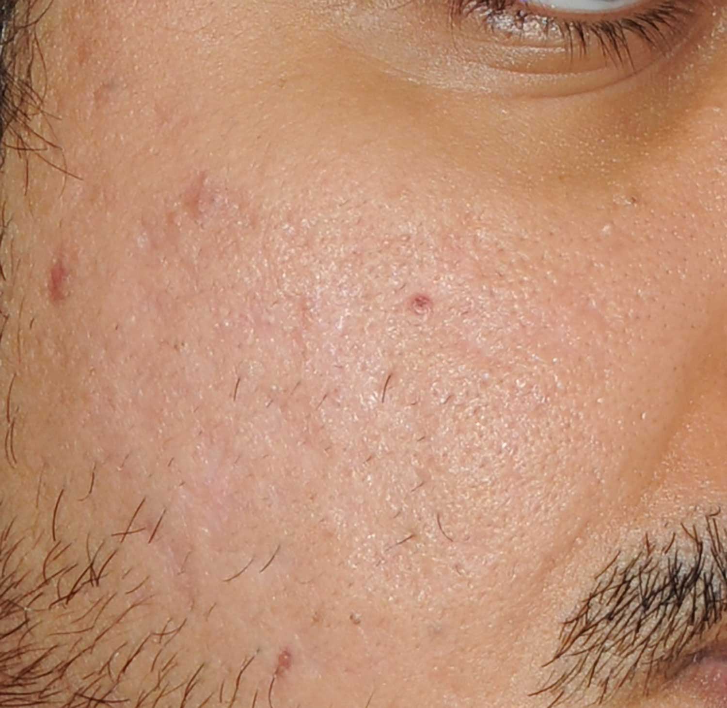 Acne Scar Treatment Before & After Photo