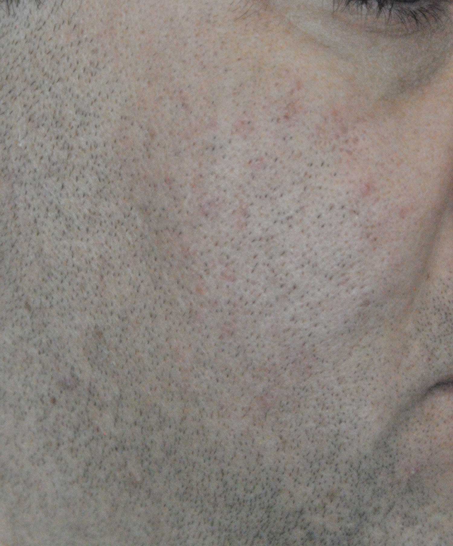 Acne Scar Treatment Before & After Photo