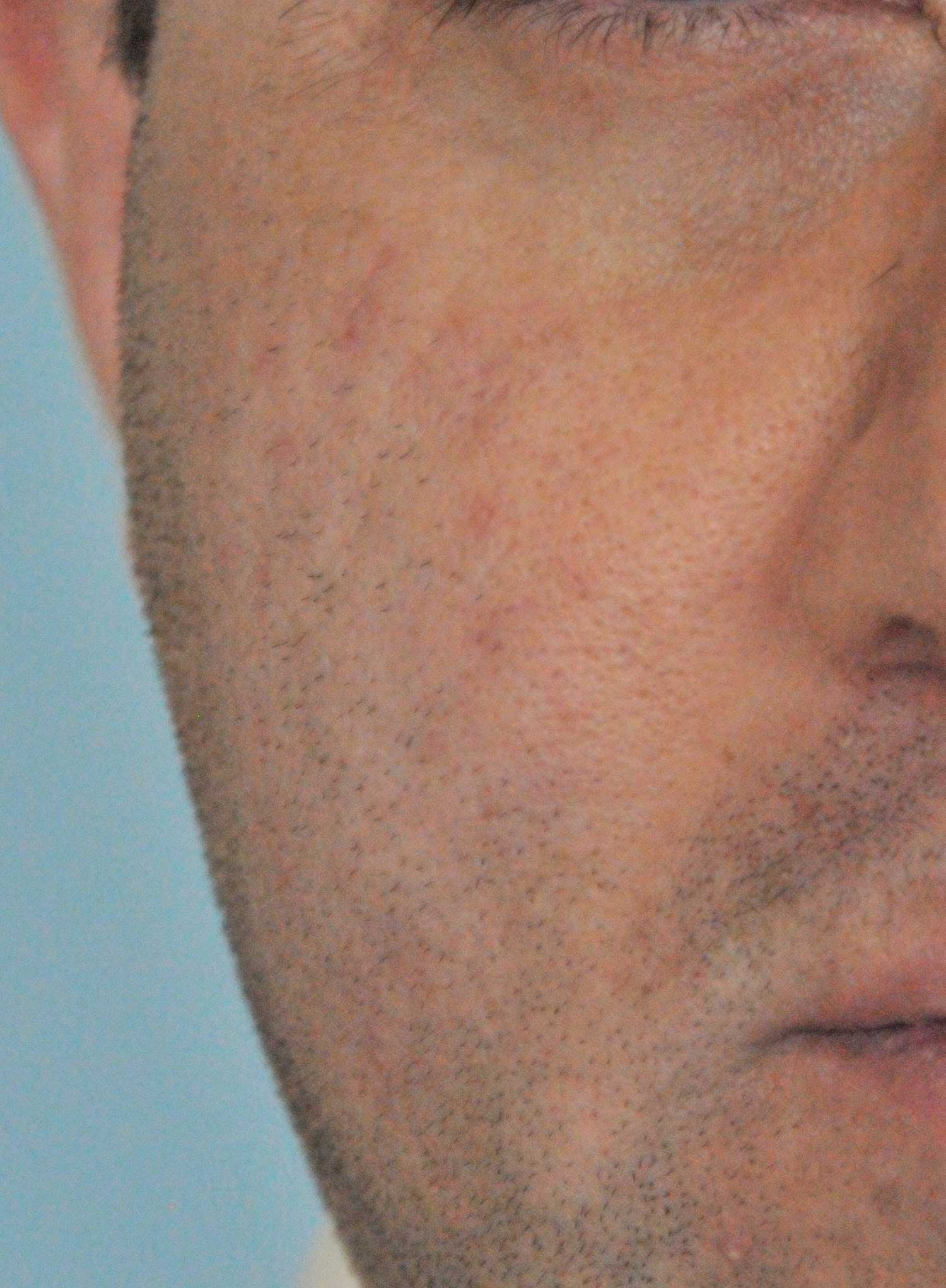 Acne Scar Treatment Before & After Photo