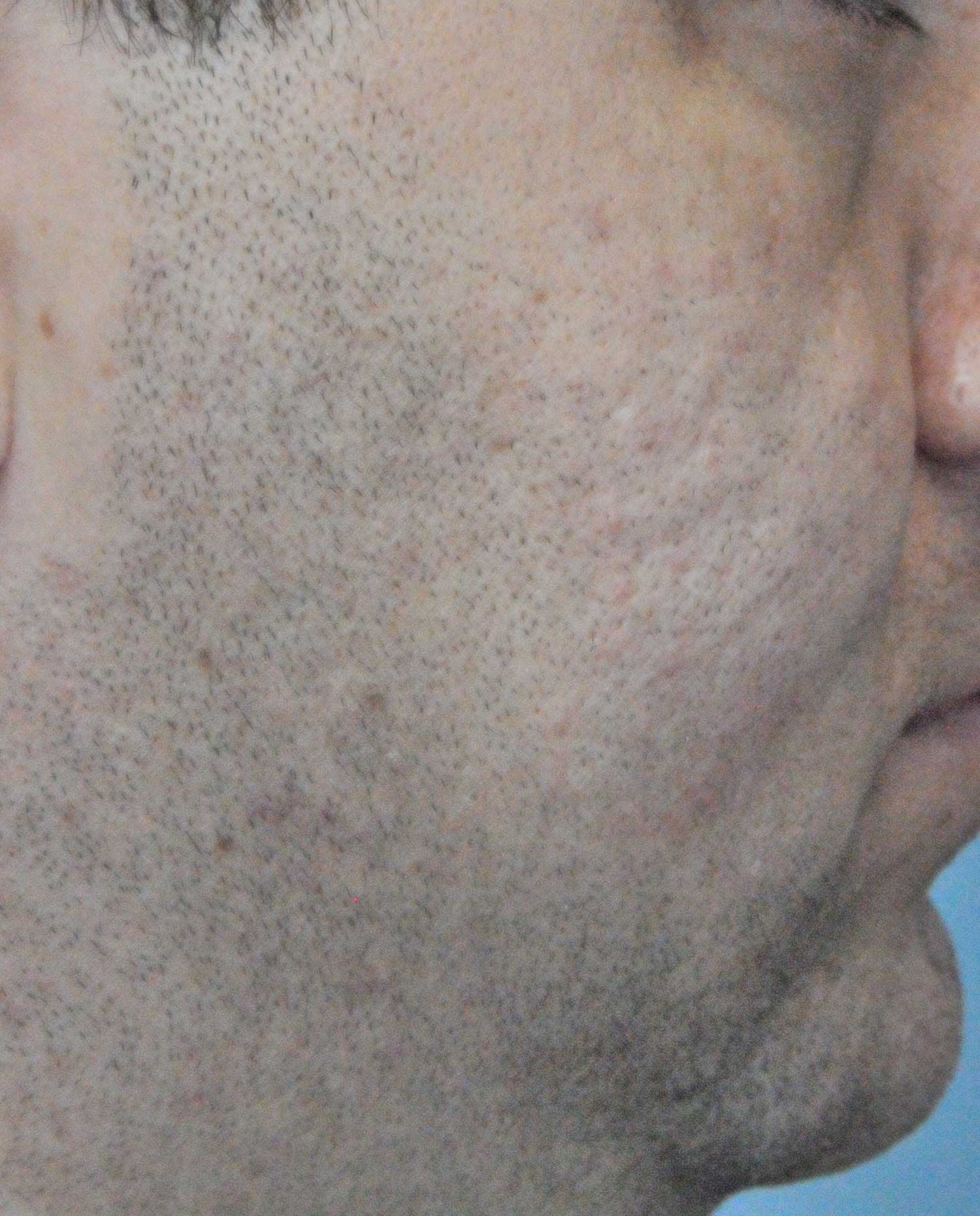 Acne Scar Treatment Before & After Photo