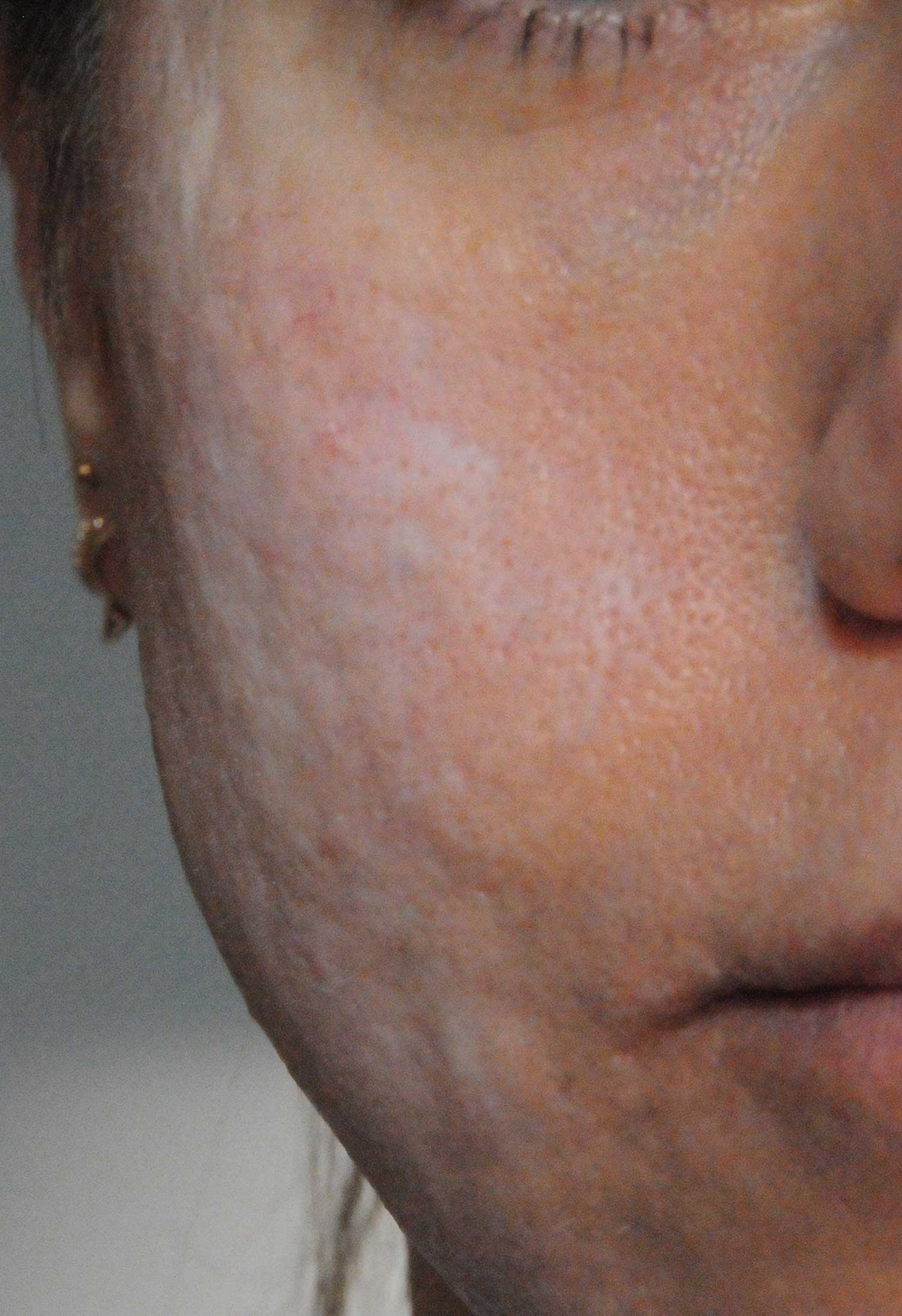 Acne Scar Treatment Before & After Photo