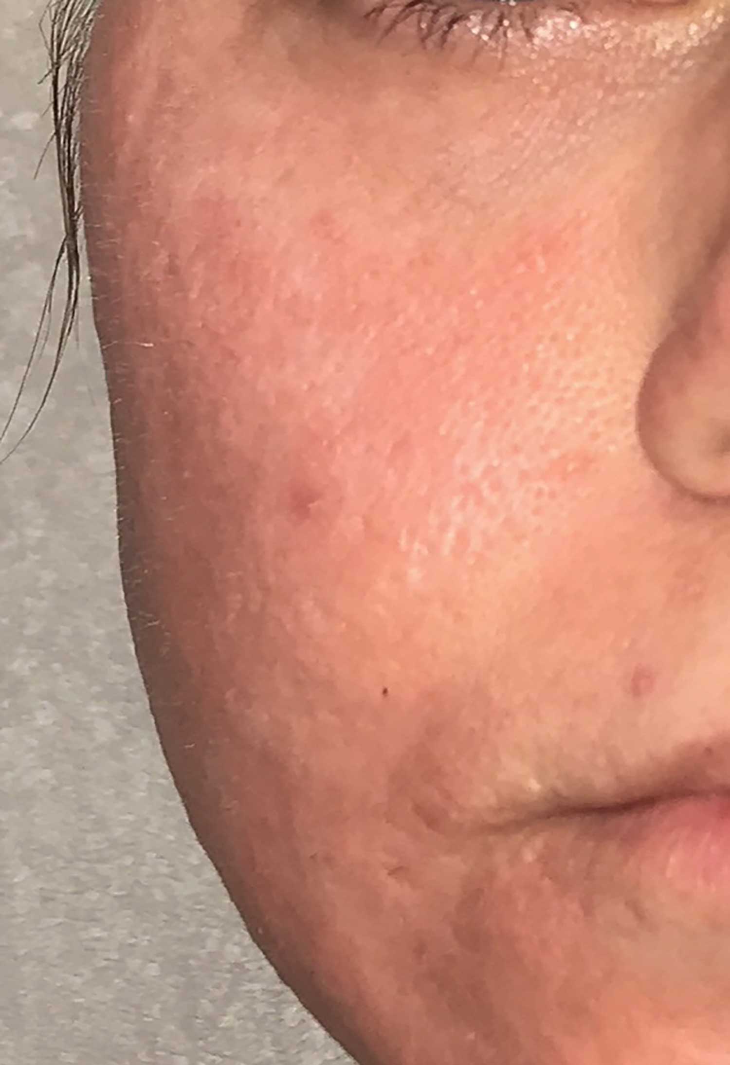 Acne Scar Treatment Before & After Photo