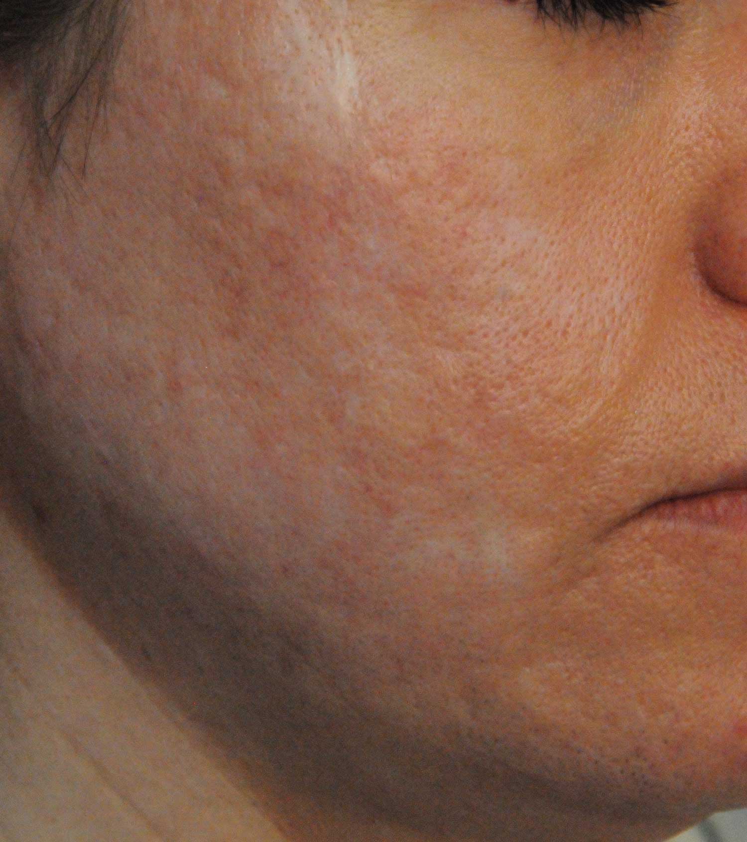 Acne Scar Treatment Before & After Photo