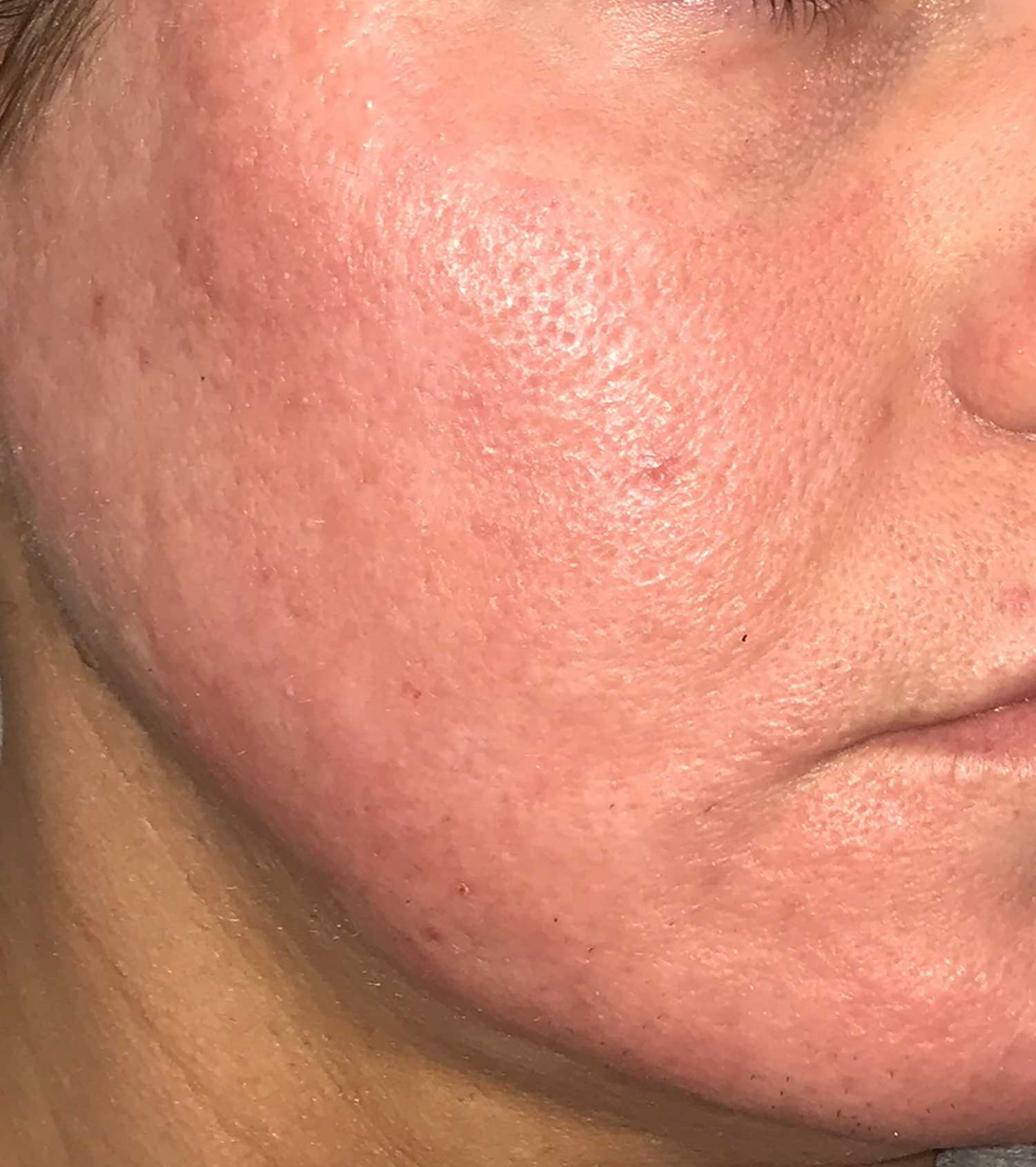 Acne Scar Treatment Before & After Photo