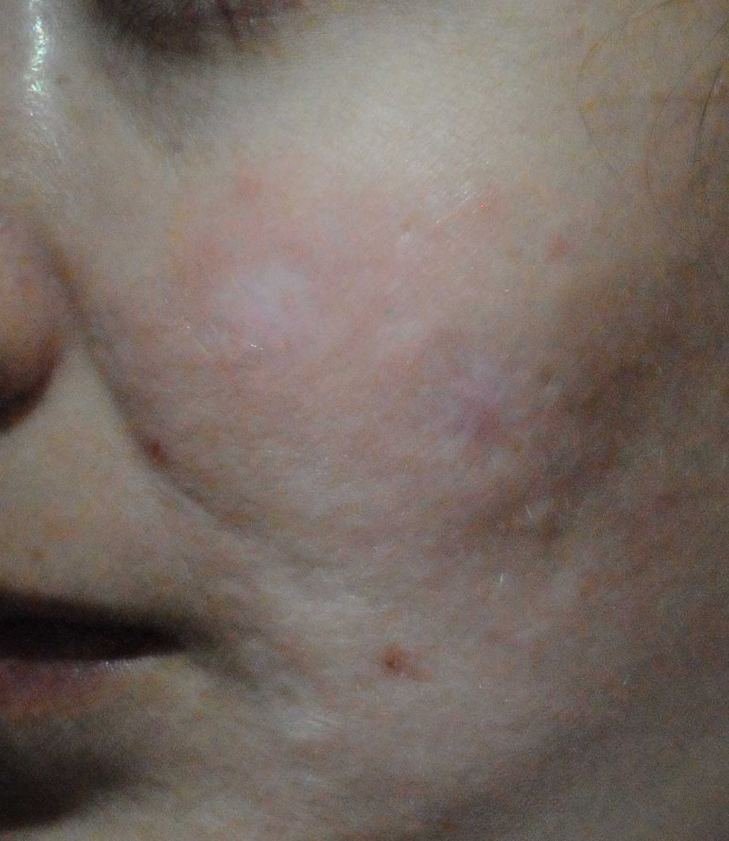 white acne scars on face