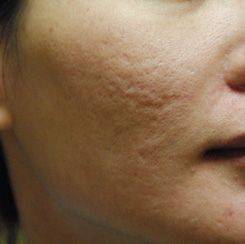 Acne Scar Treatment Before & After Photo