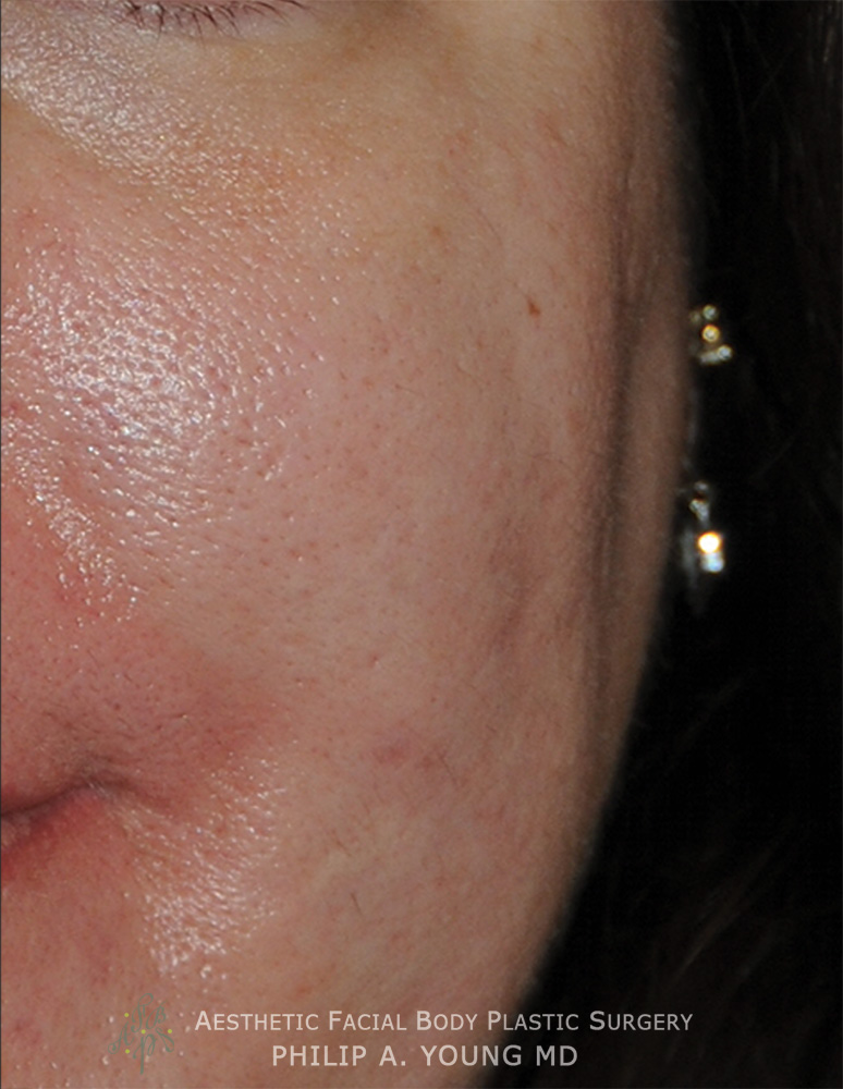 Acne Scar Treatment Before & After Photo