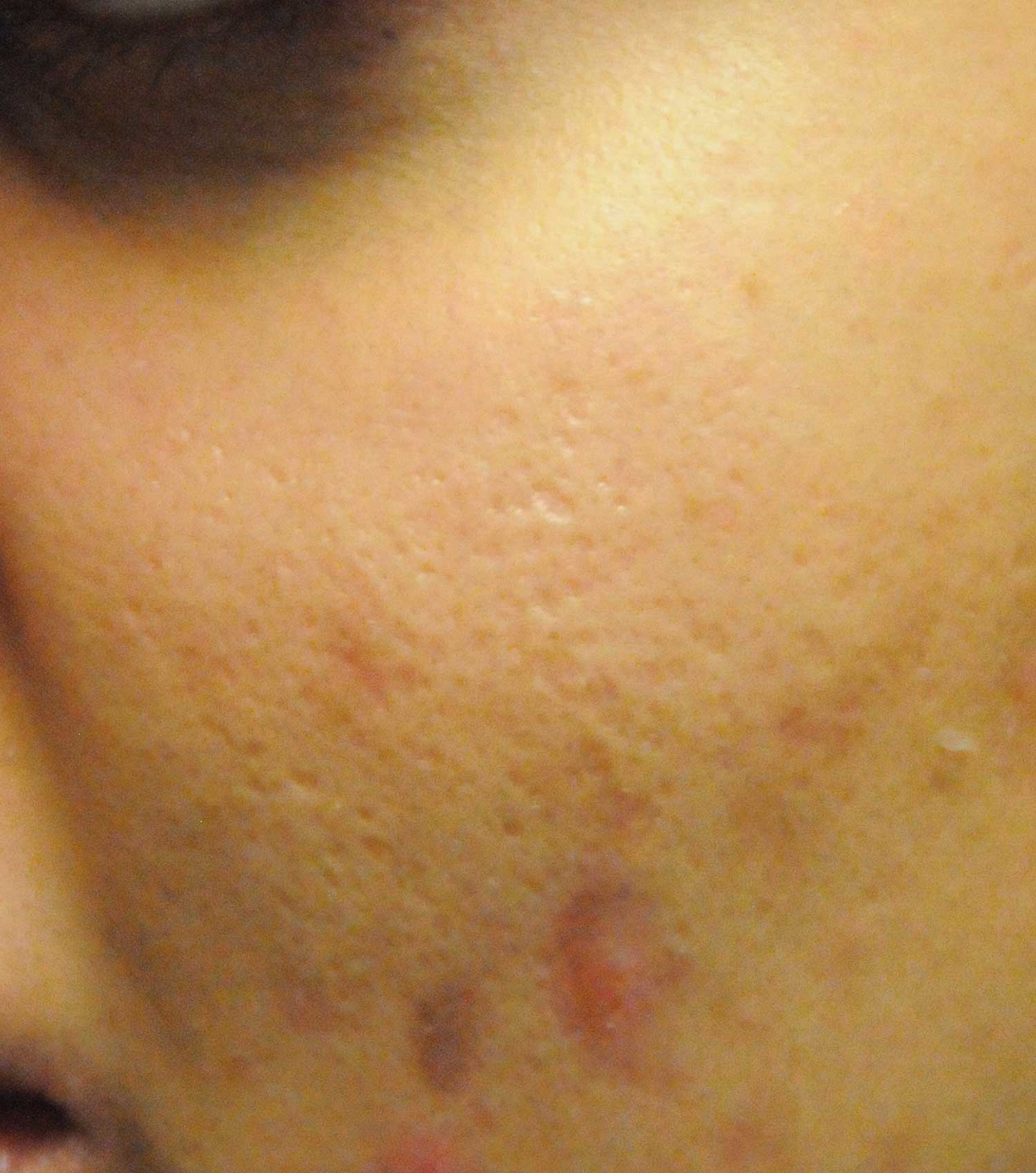 Acne Scar Treatment Before & After Photo