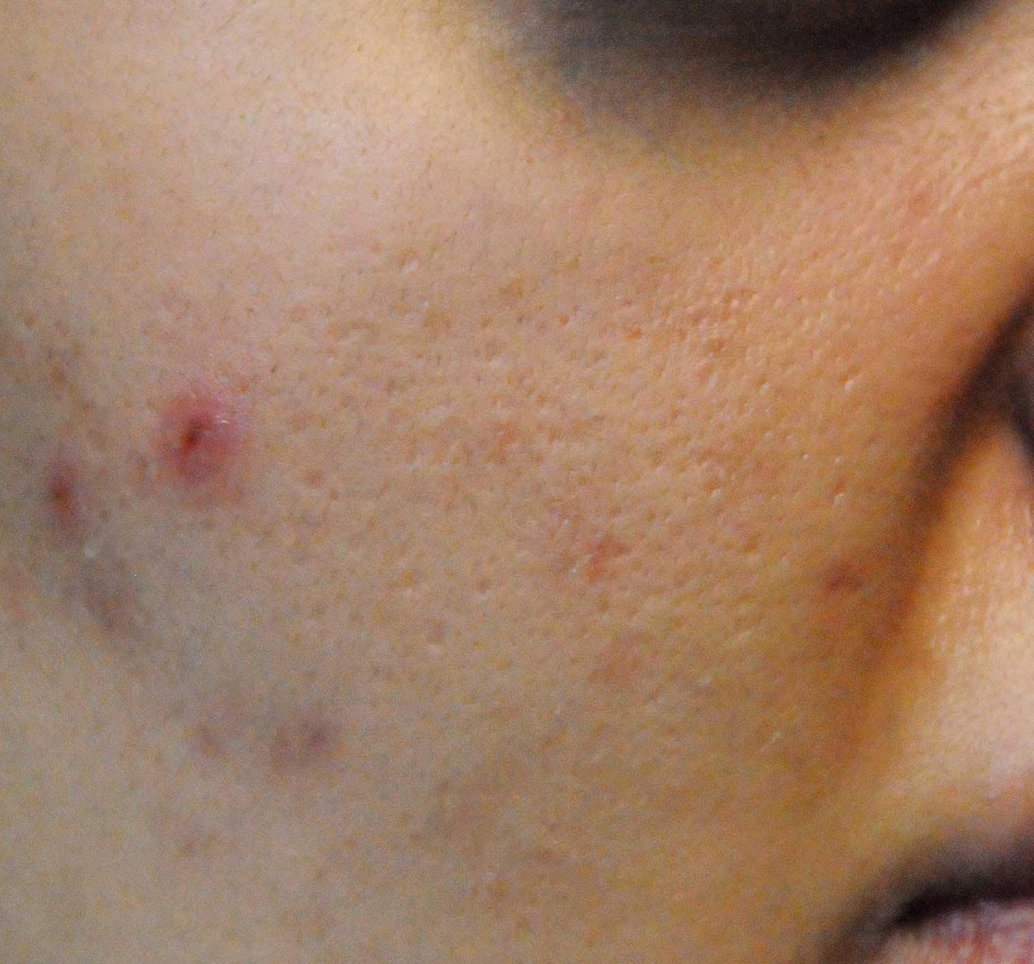 Acne Scar Treatment Before & After Photo