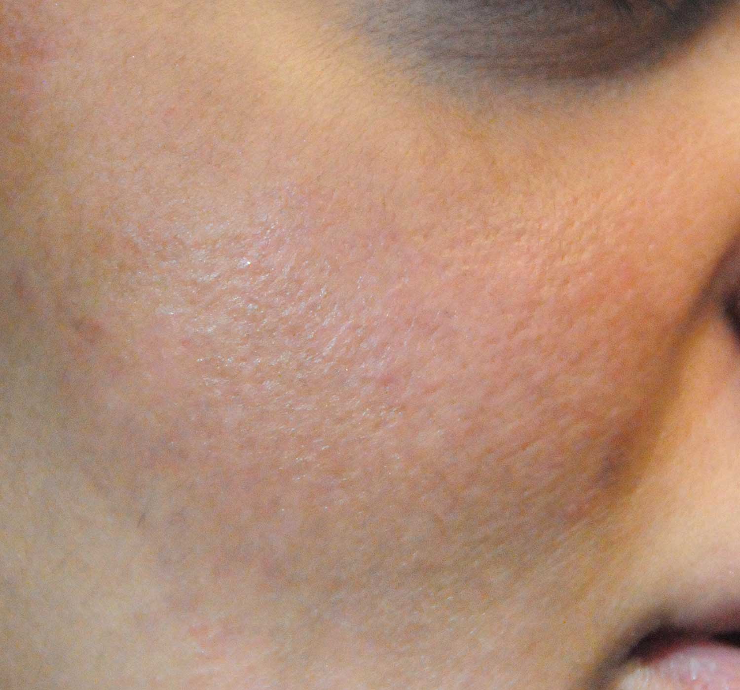 Acne Scar Treatment Before After Photos Seattle Bellevue