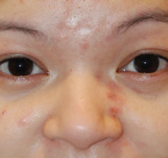 Acne Scar Treatment Before & After Photo