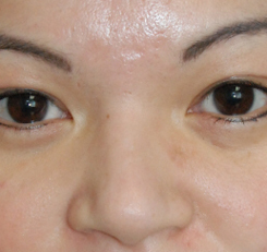 Acne Scar Treatment Before & After Photo