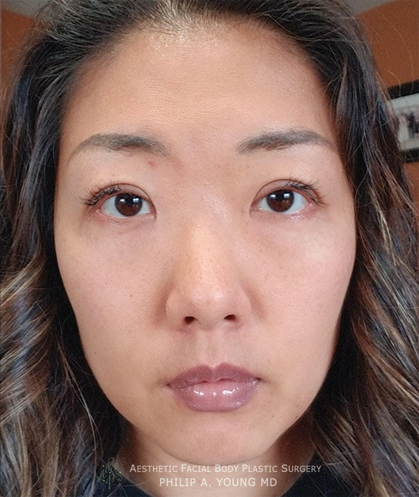 Asian Plastic Surgery Before And After Photos Seattle Bellevue 