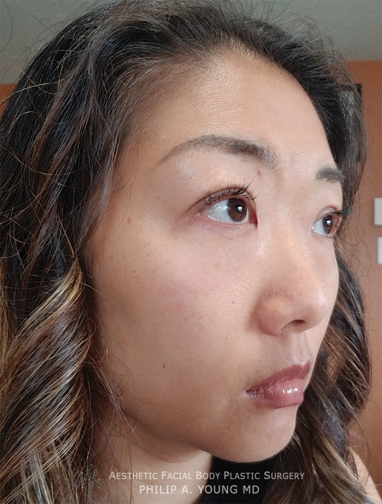 Asian Plastic Surgery Before and After Photos Seattle Bellevue