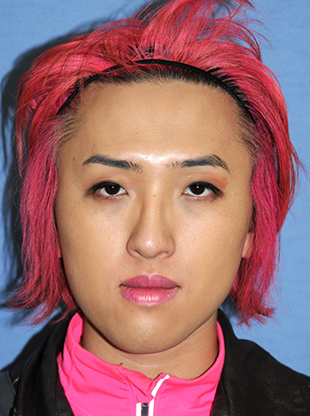 Asian Plastic Surgery Before & After Photo