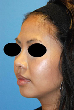 Asian Plastic Surgery Before & After Photo