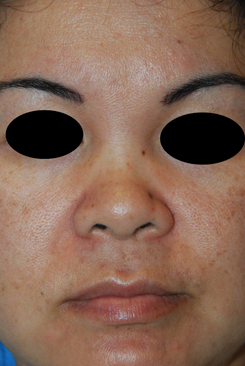 Asian Plastic Surgery Before & After Photo