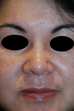 Asian Plastic Surgery Before & After Photo