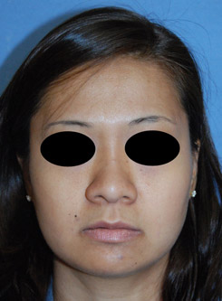 Asian Rhinoplasty Before & After Photo