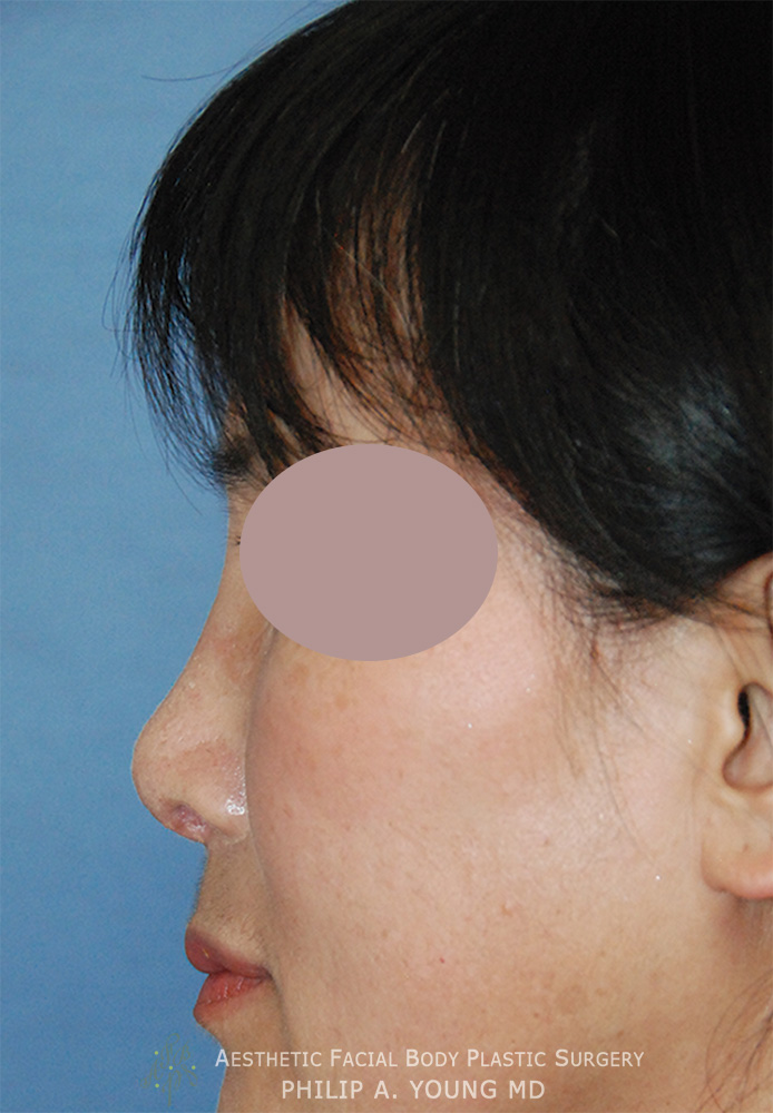 Asian Rhinoplasty Before & After Photo