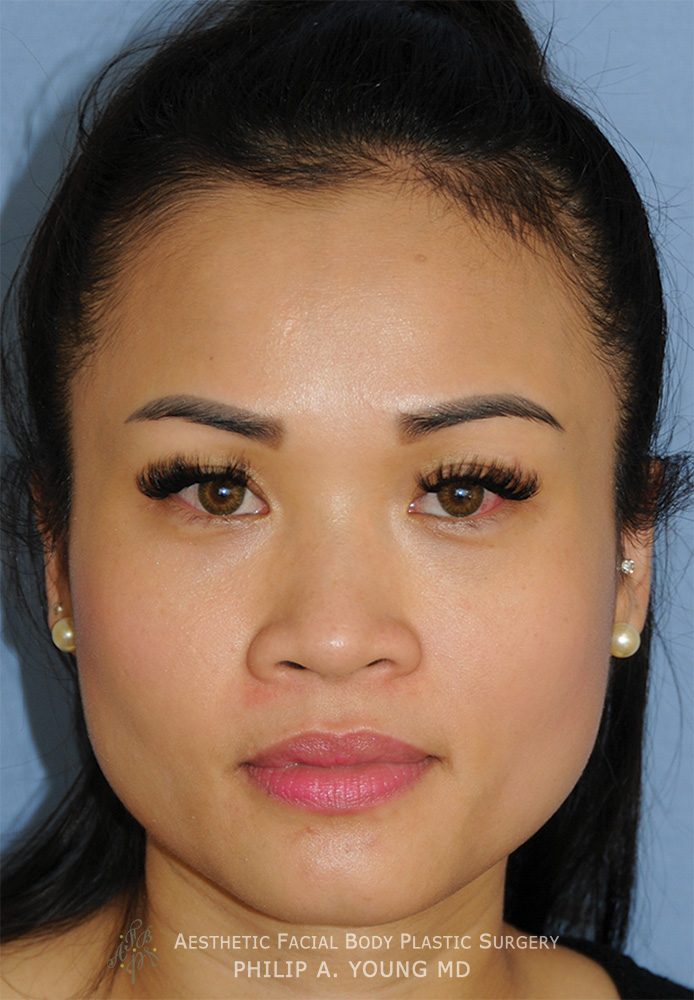 Asian Rhinoplasty Before & After Photos Seattle Bellevue