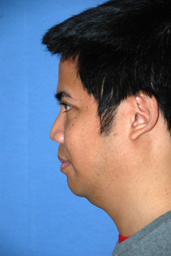 Asian Rhinoplasty Before & After Photo