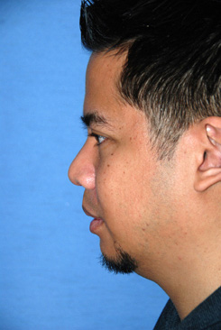 Asian Rhinoplasty Before & After Photo