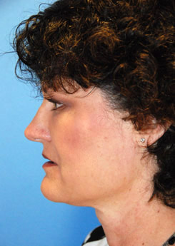 Cheek Implant Before & After Photo