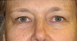 Eyelift Before & After Photo