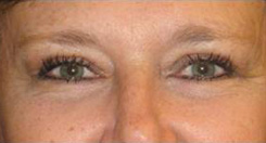 Eyelift Before & After Photo