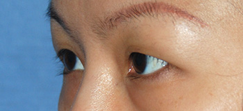 Eyelift Before & After Photo