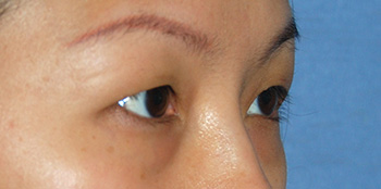 Eyelift Before & After Photo