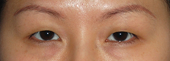 Eyelift Before & After Photo