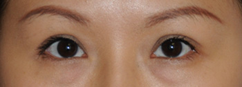 Eyelift Before & After Photo