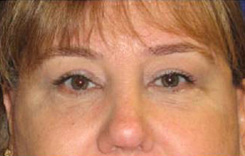 Eyelift Before & After Photo