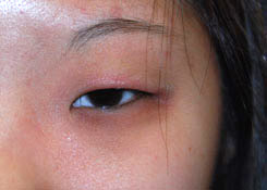 Eyelift Before & After Photo